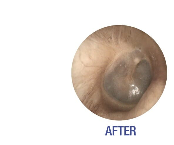 after earwax removal