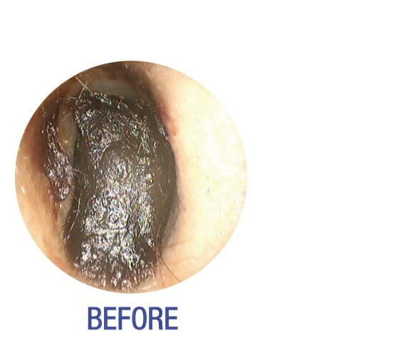 before earwax removal